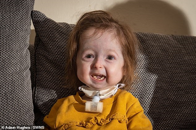 Редкая болезнь: 2-летняя девочка из-за мутации превратилась в старушку (ФОТО)